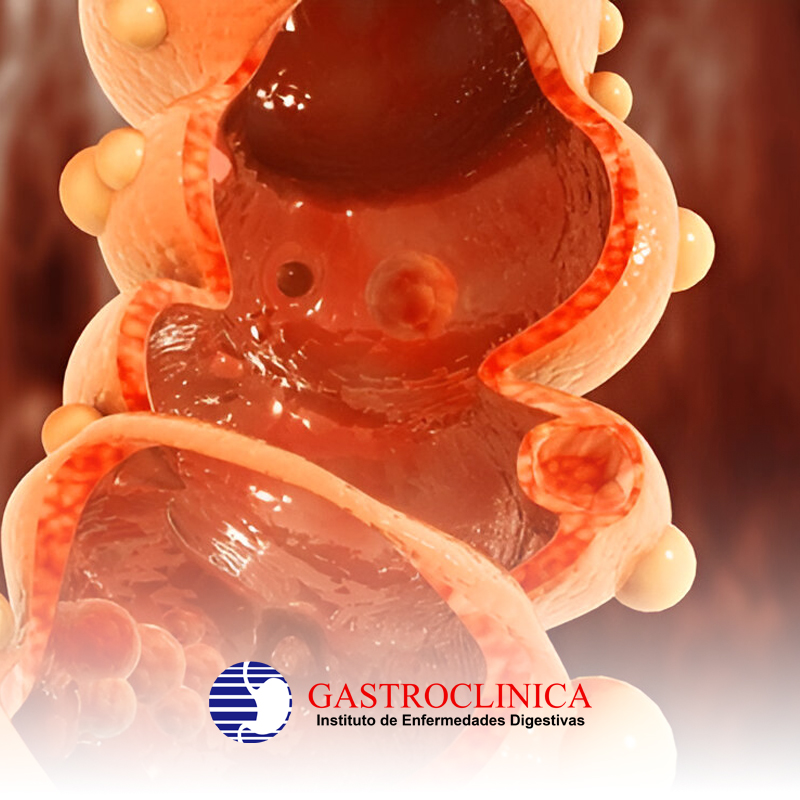 Publicacion: 🩺 La forma más sencilla y efectiva de saber si tienes Helicobacter pylori