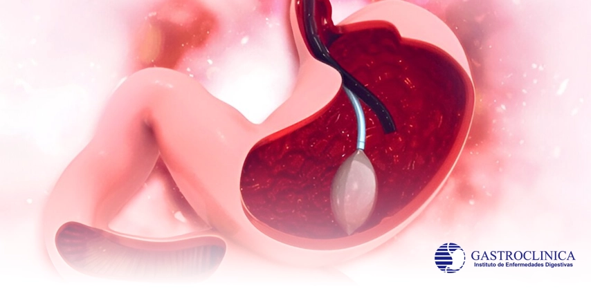 Servicio Balón Ajustable Intragástrico