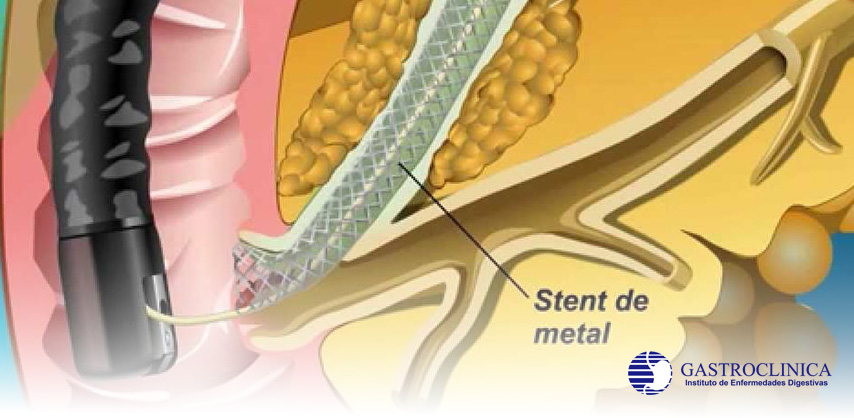 Servicio ERCP o CPRE