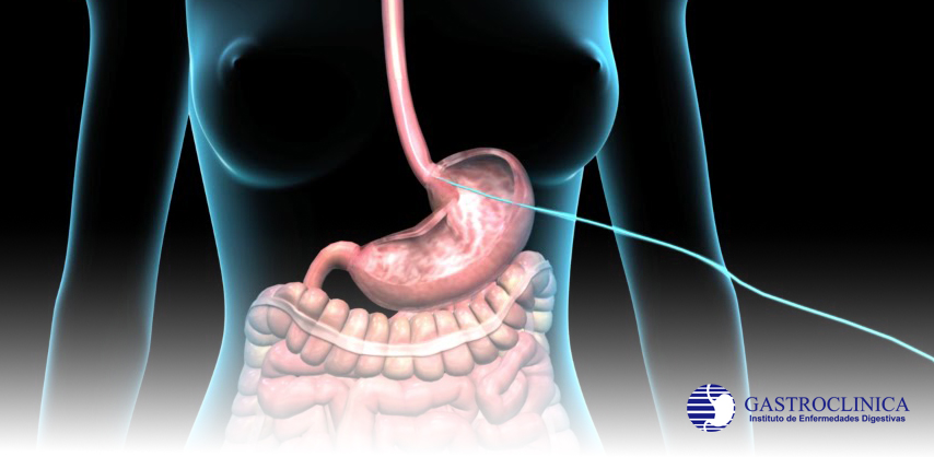 Servicio Gastrostomía Endoscópica Percutánea