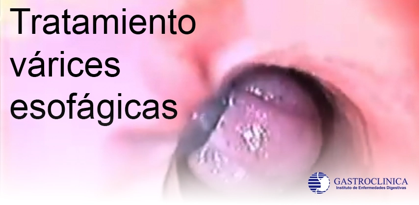 Servicio Tratamiento de Várices Esofágicas